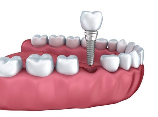 Trong-rang-implant