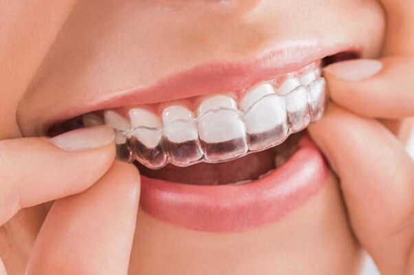 nieng-rang-Invisalign